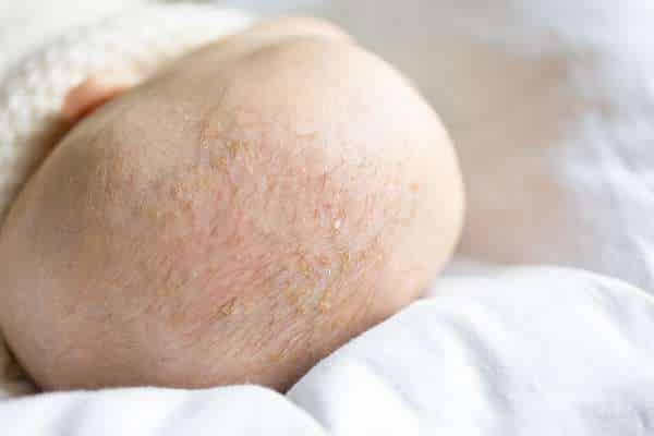 Addressing Sensitive Scalps for baby